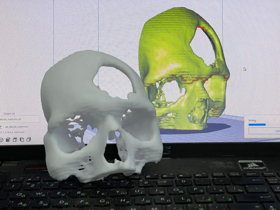 Кировские травматологи применяют 3D-печать для подготовки к операциям